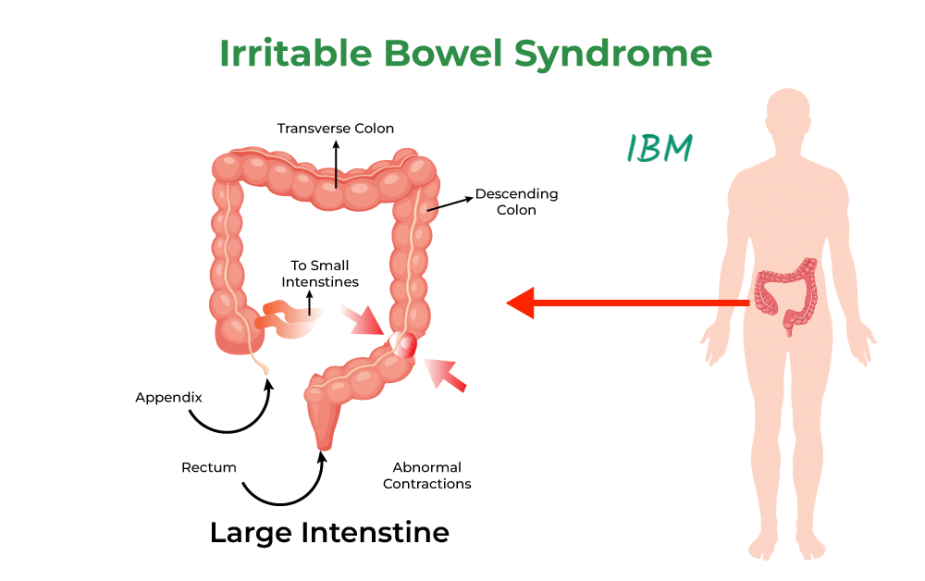 Irritable Bowel Syndrome (IBS)